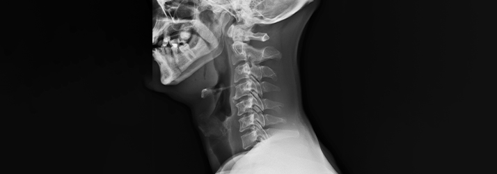 Chiropractic Vacaville CA X-Ray Spine